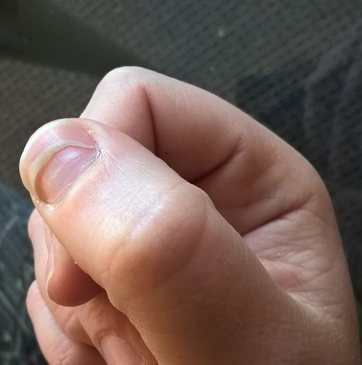 fascinating photos - stevens johnson syndrome nails