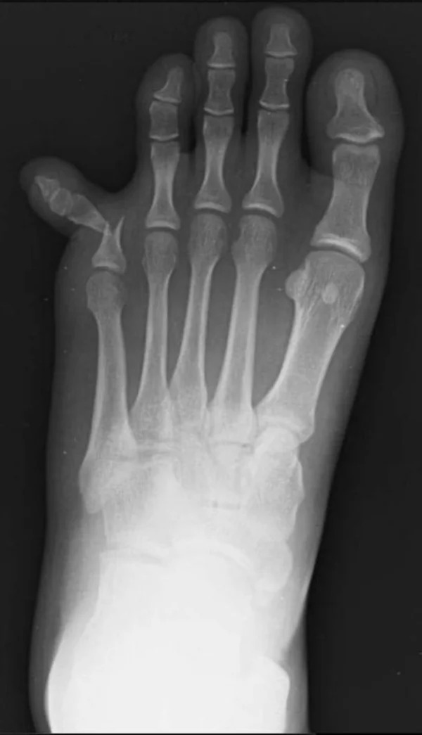 people having a bad day -  normal foot x ray - Pan