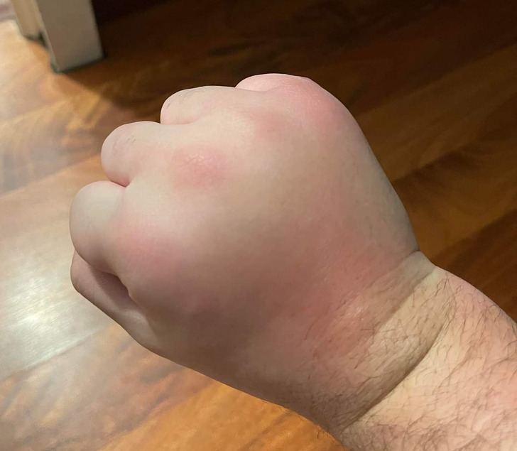 “My friend got stung by something.”