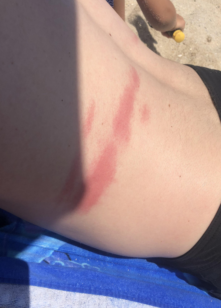 “First time swimming in the ocean in over 5 years; got stung by a small jellyfish within 2 minutes.”