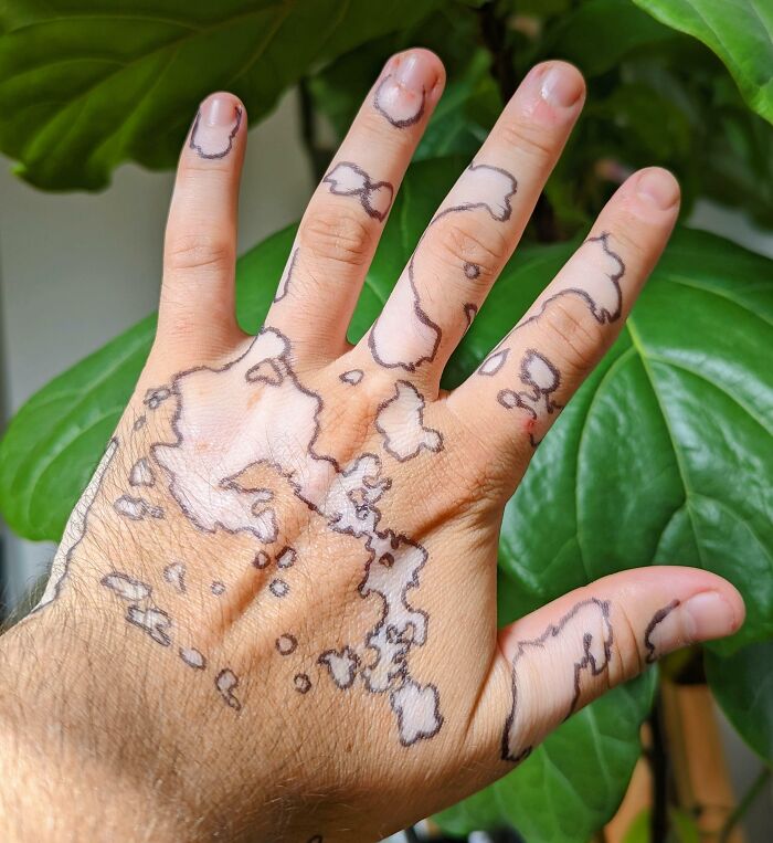 I Traced Around My Vitiligo Spots