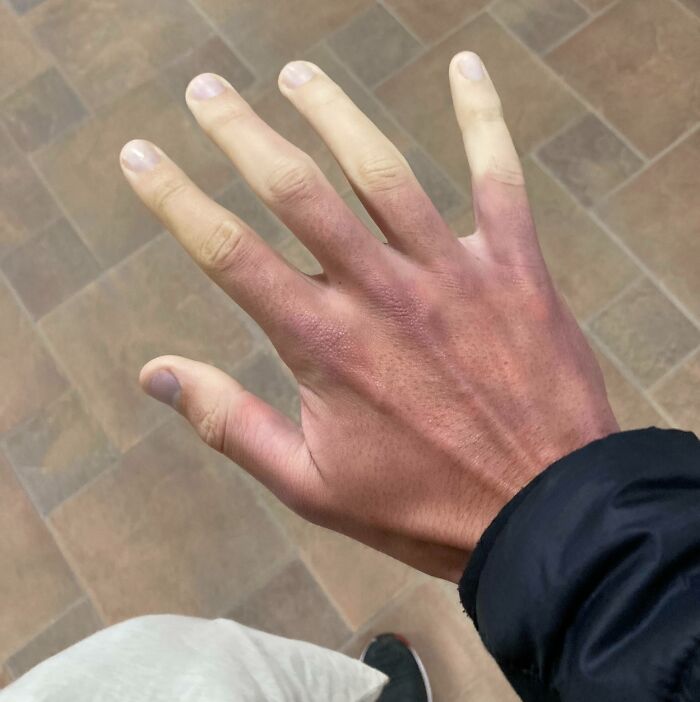 I Have This Thing Called Raynaud’s Disease. This Happens Every Time I Get Cold