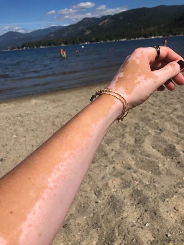 “The way my skin tries to re-pigment in the summer (all of the little dots are new pigment)”