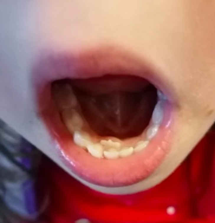 “My daughter has got an adult tooth poking out behind her baby teeth.”