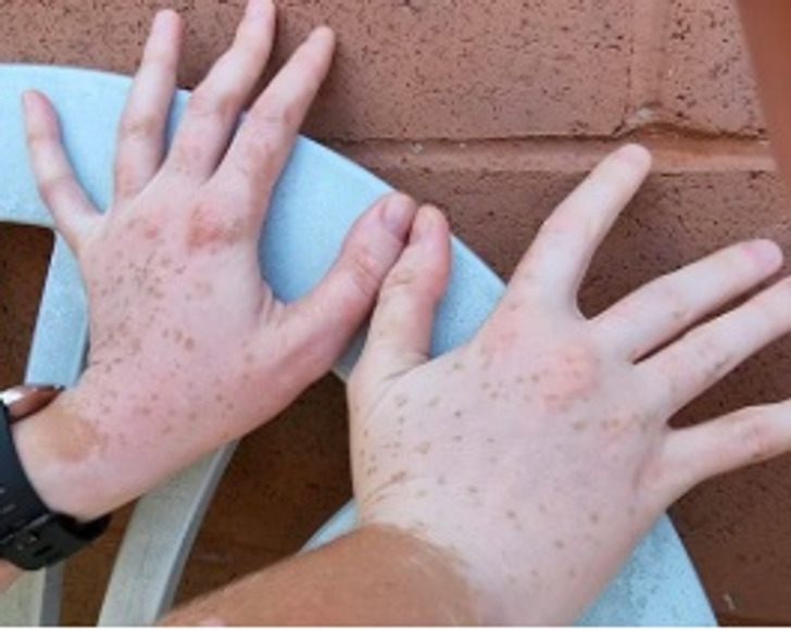 “My hands are super speckled this year, last summer I had completely white hands. I’m interested to see what happens next year.”