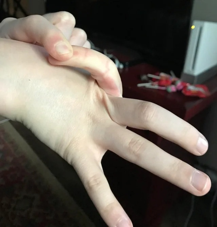“How I can bend my finger to the back of my hand”