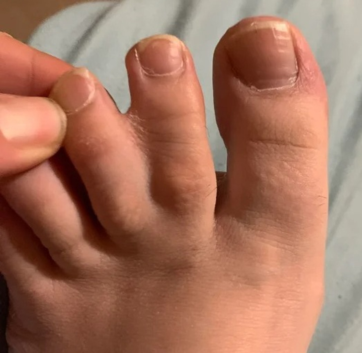 “2 of my toes on both feet are stuck together.”