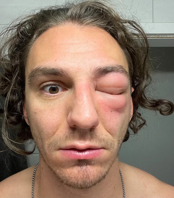 “Got stung in the eye at 2am while asleep by probably one of the last wasps of the season.”