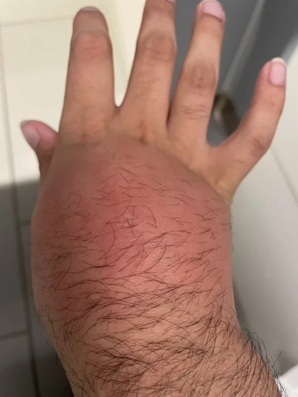 “All this just from a small mosquito bite.”