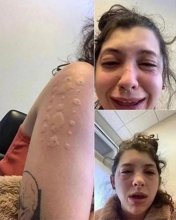 People who had a bad day - allergy test allergic to everything