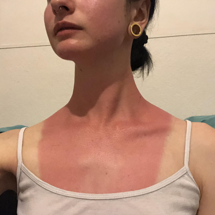 ’’I went out on a boat without sunscreen.’’