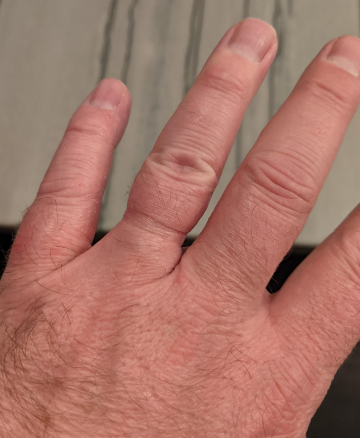 ’’My wedding ring was a little tight when we got it 20 years ago, finally had to cut it off today.’’