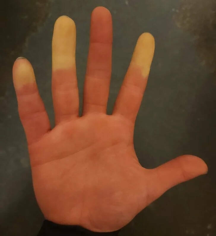 “Having Raynaud’s syndrome is weird.”