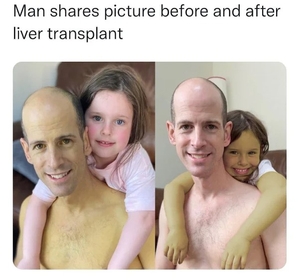 WTF memes and pics - before and after liver transplant - Man picture before and after liver transplant