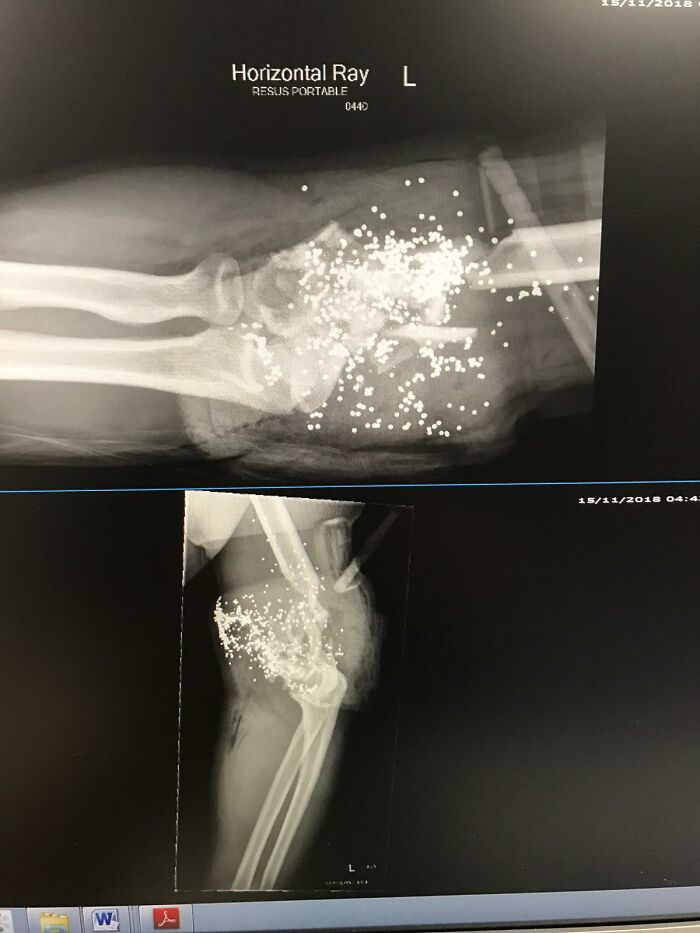 What Getting Shot In The Elbow With A 12 Gauge Shotgun Looks Like On X-Ray