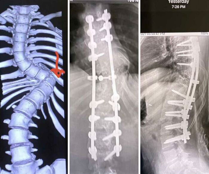 A Friend Of Mine Had Scoliosis And This Is Pictures From Their Surgery