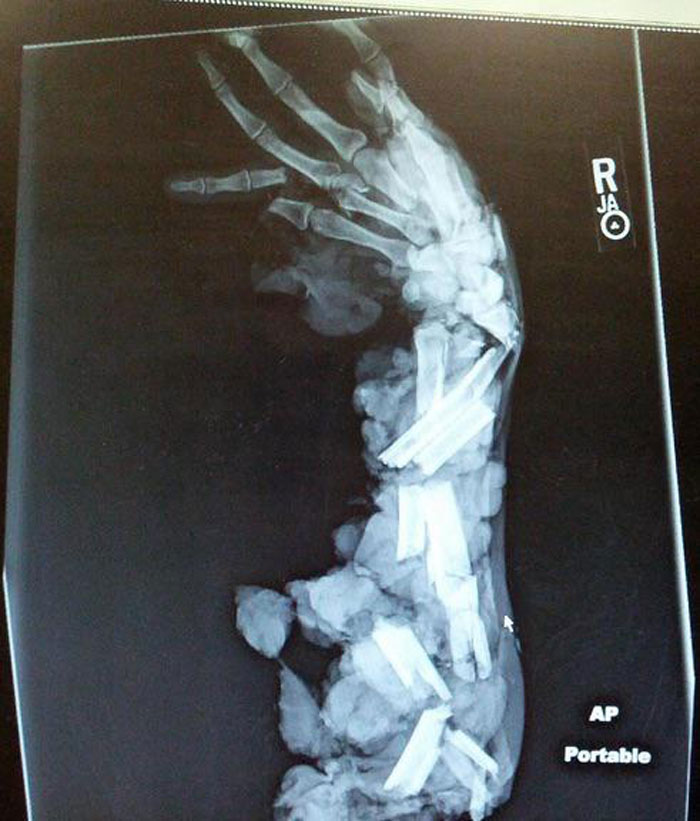 An X-Ray Of A Man’s Arm That Was Crushed By A Meat Grinder