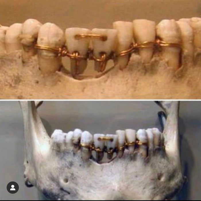 Ancient Egyptian Dental Work