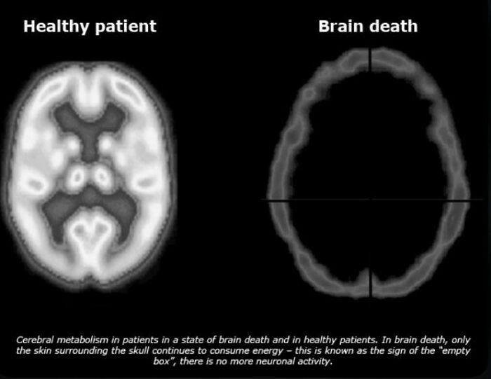 creepy and wtf pics - brain death definition - Healthy patient Brain death O Cerebral metabolism in patients in a state of brain death and in healthy patients. In brain death, only the skin surrounding the skull continues to consume energy this is known a