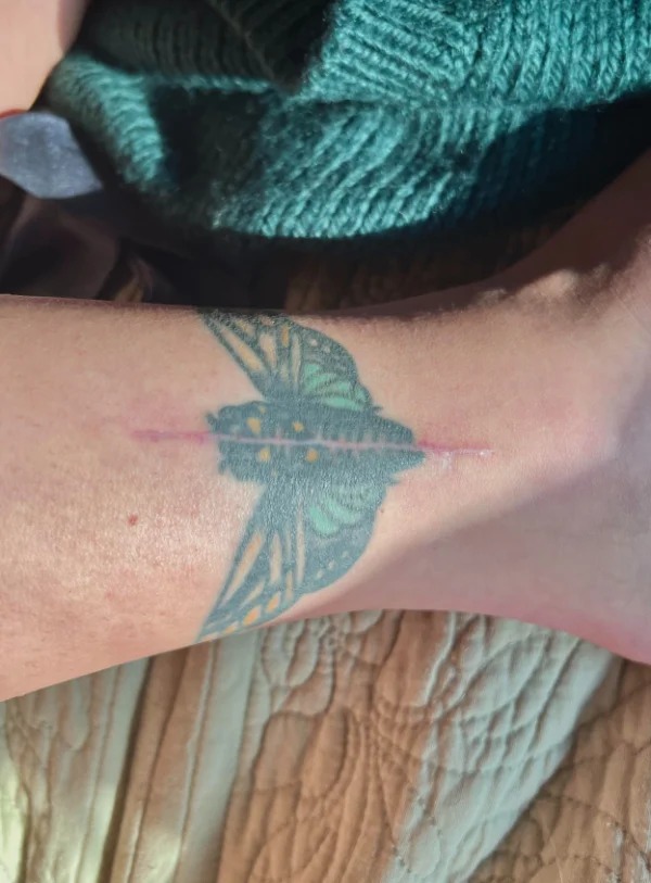 “This surgery required an incision right through the center of my tattoo.”