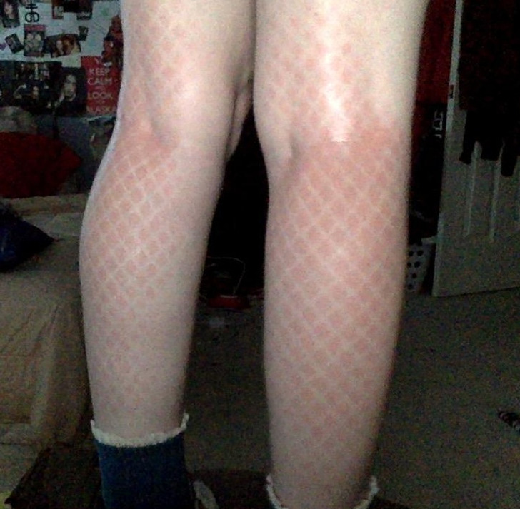 ’’I got a bad sunburn while wearing fishnet stockings.’’