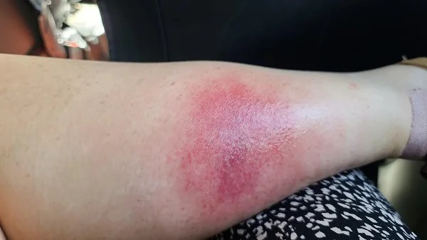 “Day 1 of a 14 day trip (Malaysia & Philippines) – Stung by a vicious hornet/wasp. The pain was excruciating, then went away. Now I can barely walk and the swelling is intense.”