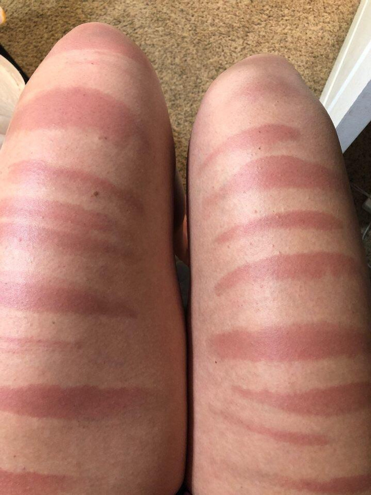 ’My cousin’s legs after a day in the sun in ripped jeans.’