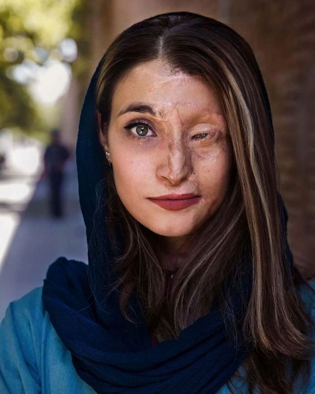 Marzieh Ebrahimi, an Iranian survivor of an unprovoked acid attack in 2014 for wearing a “bad hijab”