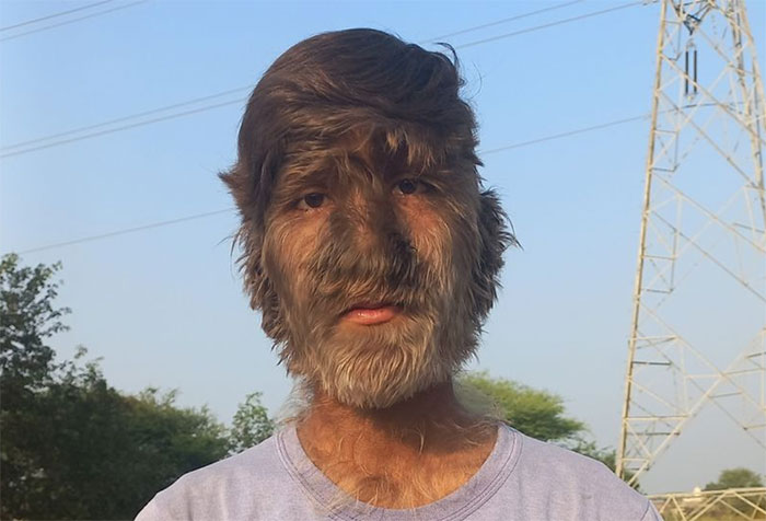 A teenager from Madhya Pradesh, India has an ultra rare condition called ‘werewolf syndrome’ (hypertrichosis). This uncurable condition is so rare that it is believed that only 50 people have had it since the Middle Ages