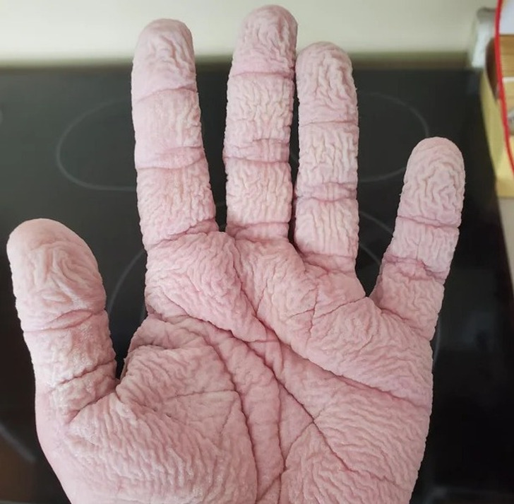 “My hands after washing the dishes for 20 minutes”