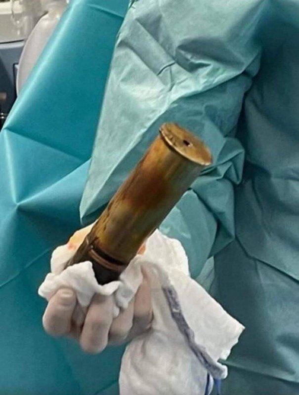 88 yo French man evacuated a whole hospital because he had a WW1 shell stuck in his anus