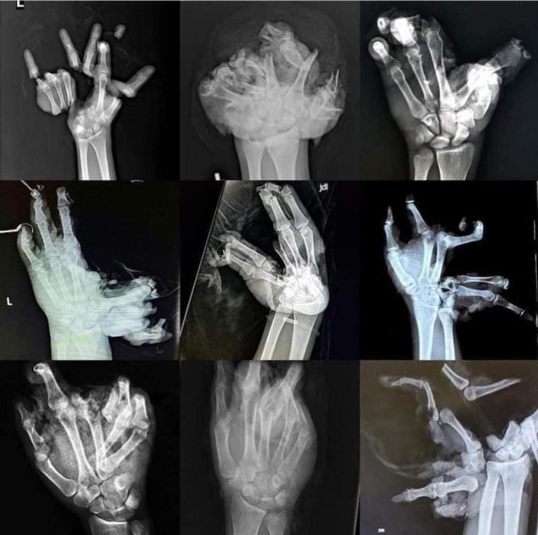 X-Rays of hands after firework accidents