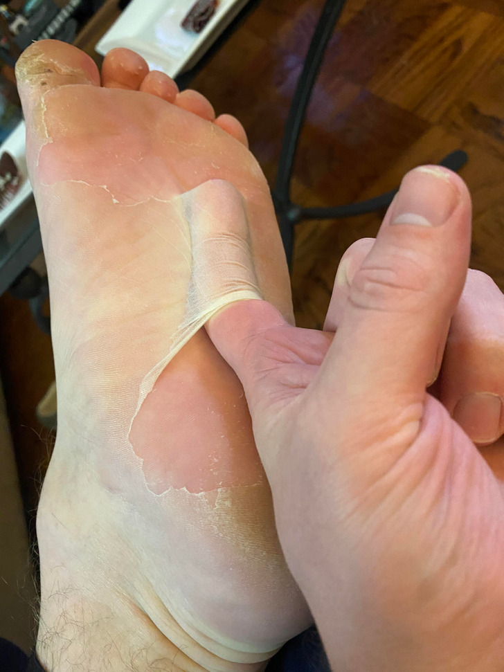 odd and interesting pics - my foot peeling