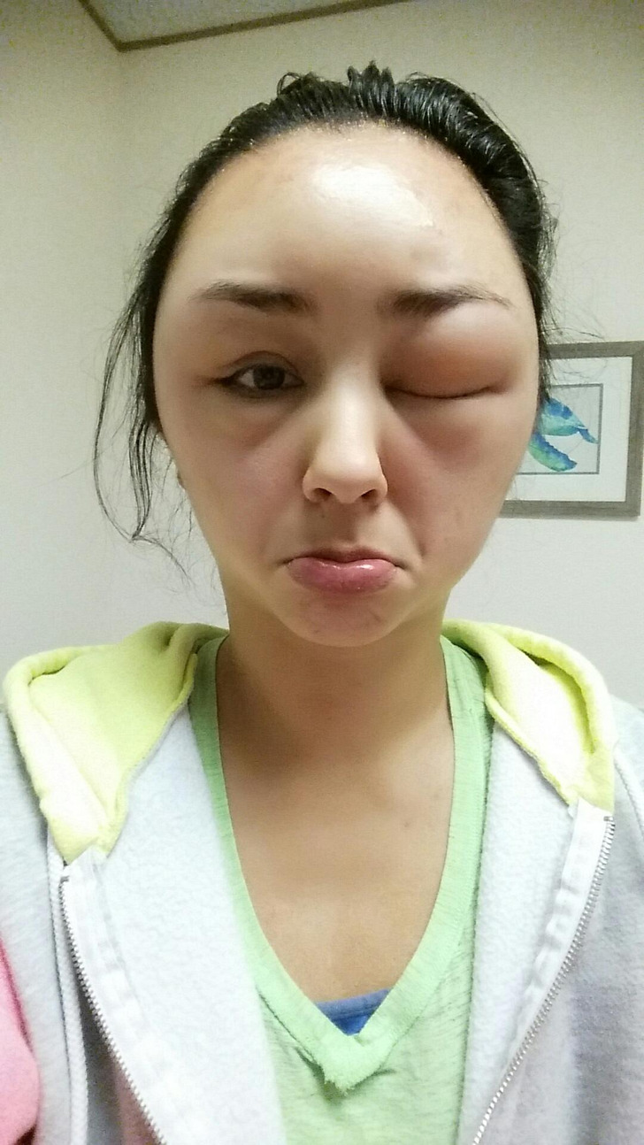 “My friend had a pretty ridiculous allergic reaction to hair dye.”