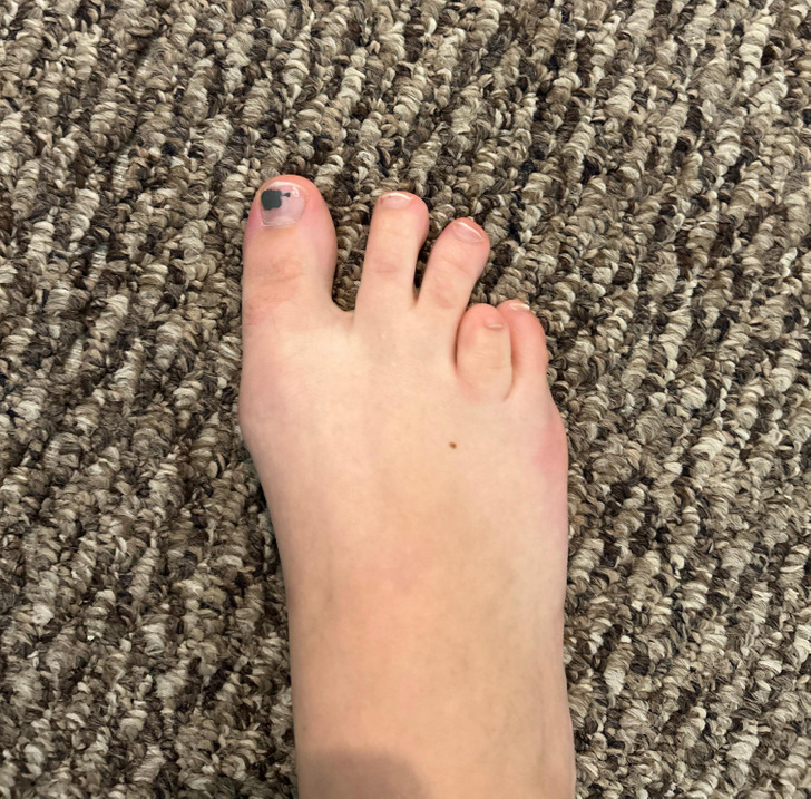 “I was born with 9.5 toes.”