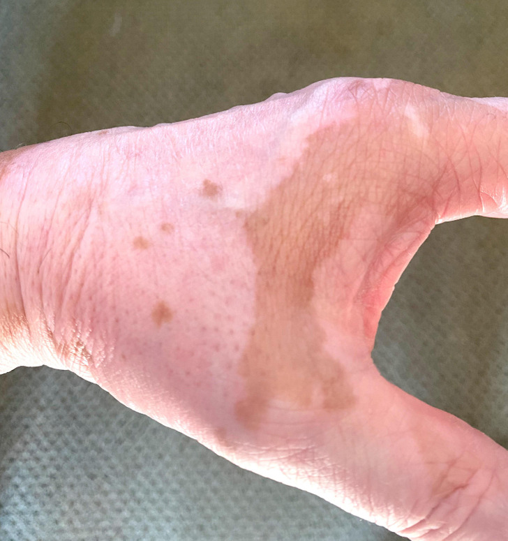 “The way that the vitiligo on my hand looks like a map of Italy”