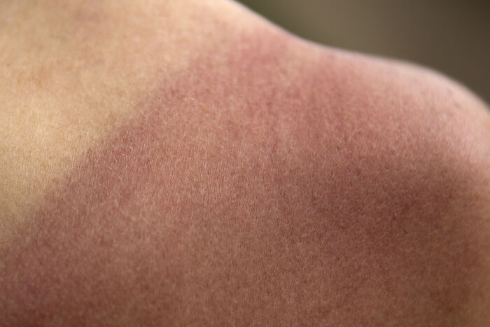 When you get a sunburn, your cells are dying to avoid becoming cancerous