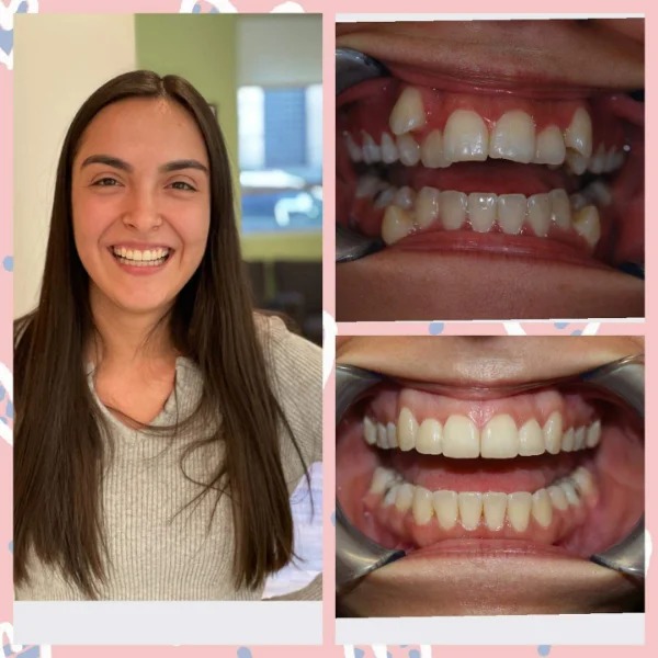 “My teeth, before and after braces.”