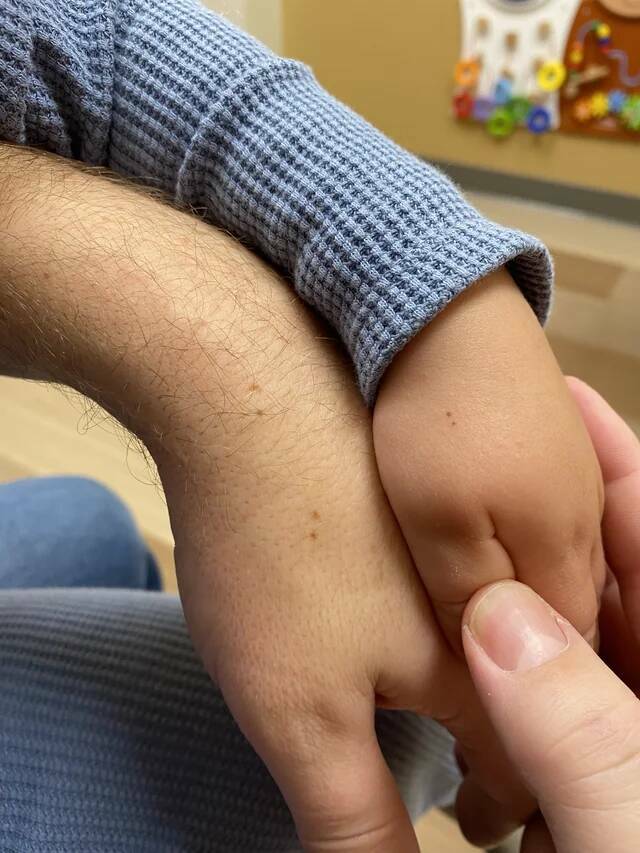 "My son and I have the same 2-freckle spot on our hands"