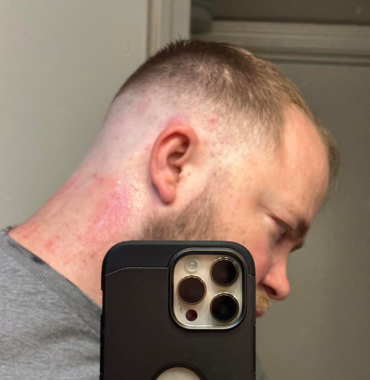 “Got a haircut at my local barber and got razor burn.”