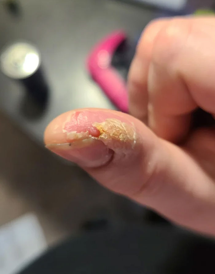 A Wart On My Thumb That Has Resisted All Treatments For Years