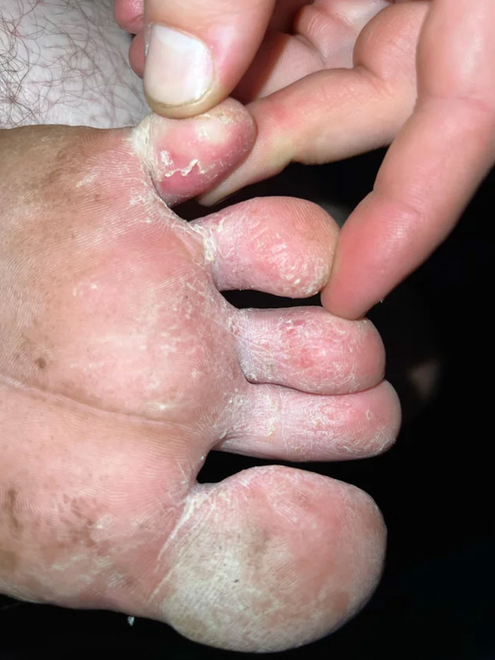 My Athletes Foot That Has “Progressed”