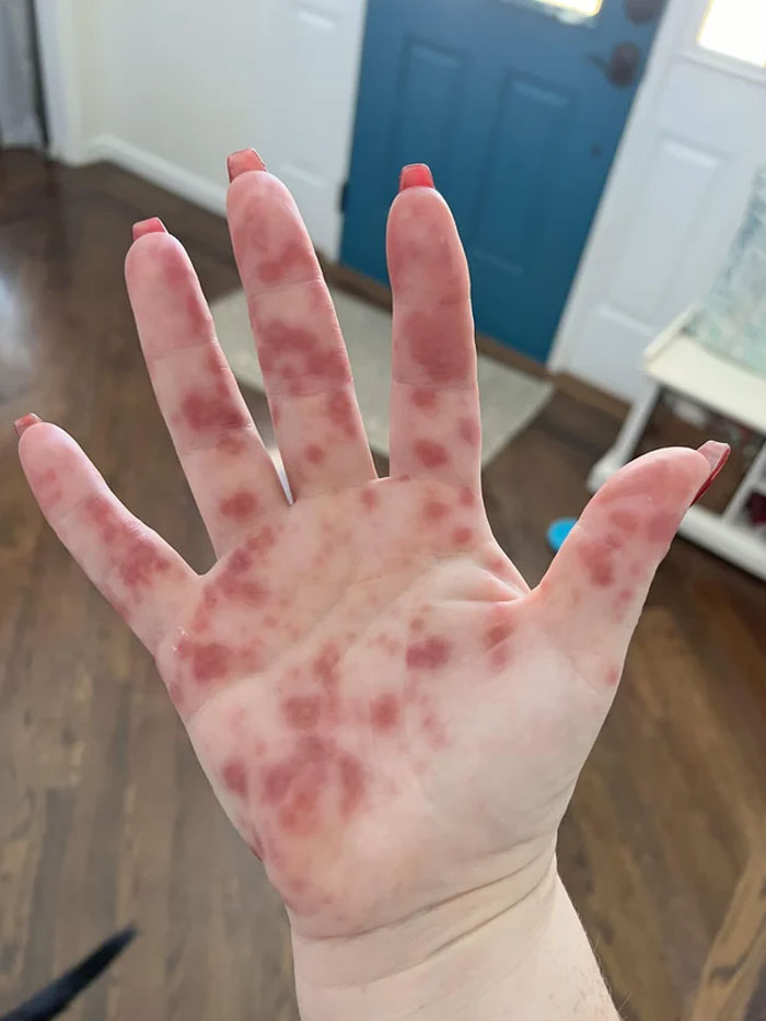 Hand-Foot-And-Mouth Disease Is No Joke!