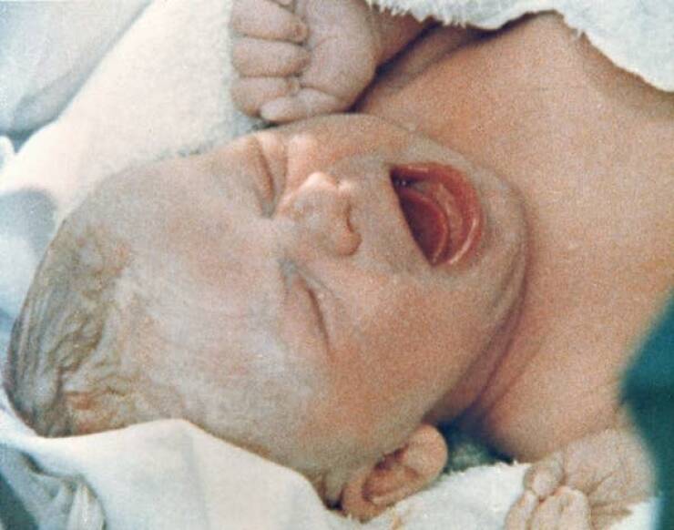 This is Louise Joy Brown, the first baby ever born after IVF, or in vitro fertilisation:Born in 1978, she was known at the time as the world's first "test-tube baby."