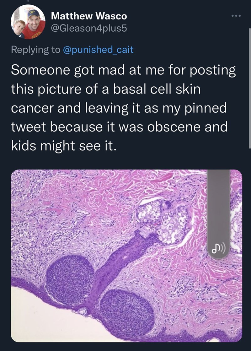 chronically online tweets - Matthew Wasco Someone got mad at me for posting this picture of a basal cell skin cancer and leaving it as my pinned tweet because it was obscene and kids might see it. Superi ...
