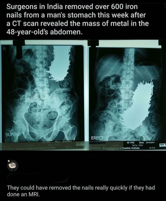 jojo metallica meme - Surgeons in India removed over 600 iron nails from a man's stomach this week after a Ct scan revealed the mass of metal in the