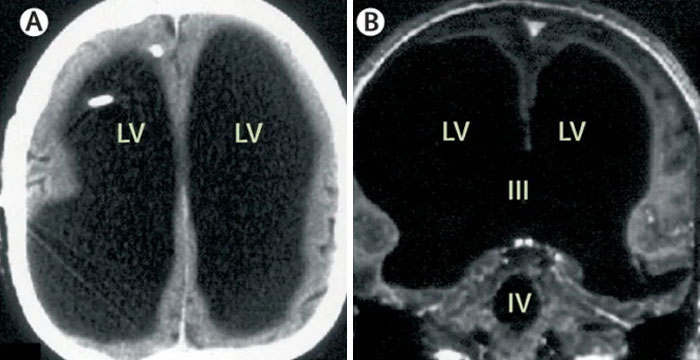 of a man who was discovered to be unknowingly missing 90% of his brain, and was living a normal life.