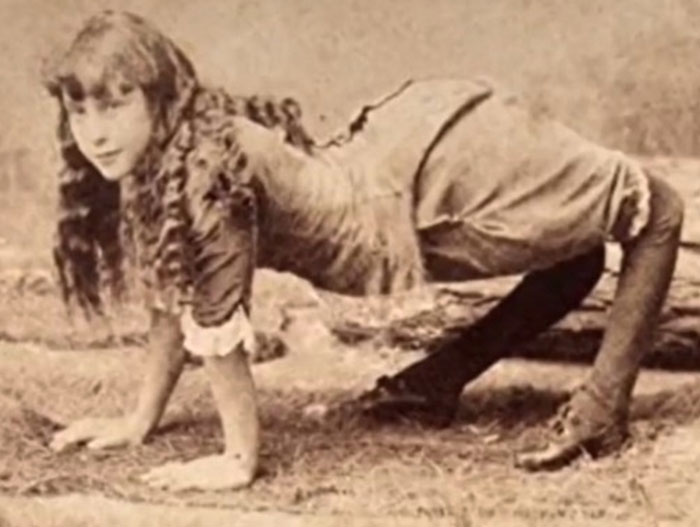 disturbing facts - Ella Harper was born with a very rare orthopedic condition that caused her knees to bend backward and was known as the camel girl