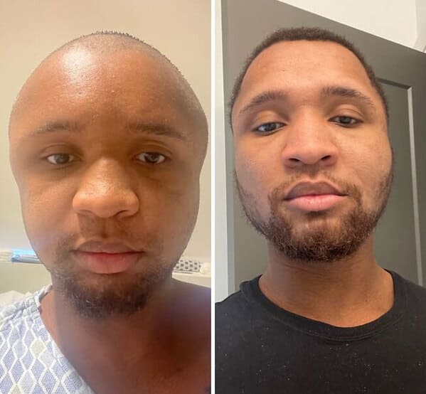 “Had My Facial Reconstruction Surgery 2 Months Ago. Was Called Megamind, Ken Griffey Jr, Jimmy Nuetron, Etc. 8 Weeks Later And Feeling A Lot More Confident In How I Look”