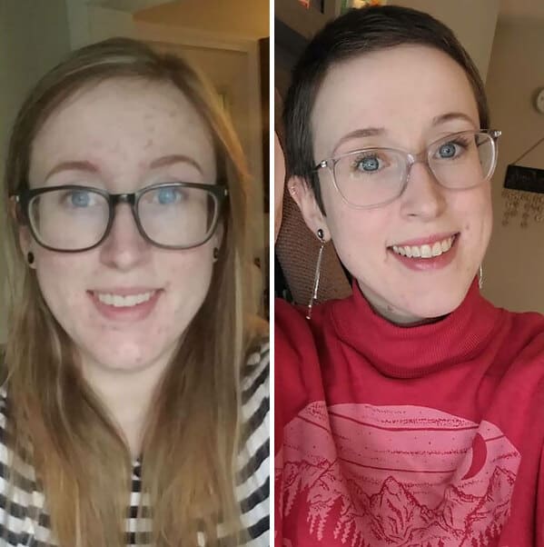 “My Appearance While Unknowingly Living With HIV For 5 Years vs. 2 Years With Treatment”